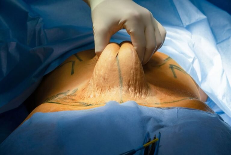 Abdominoplasty