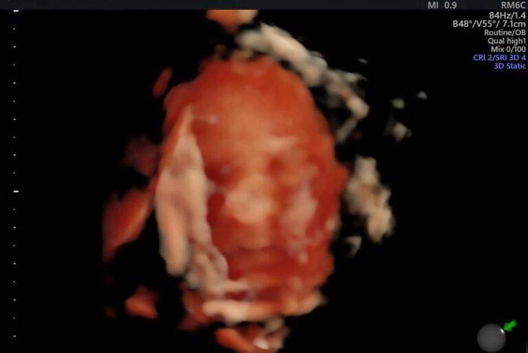 3D/4D ultrasound and pregnancy follow-up