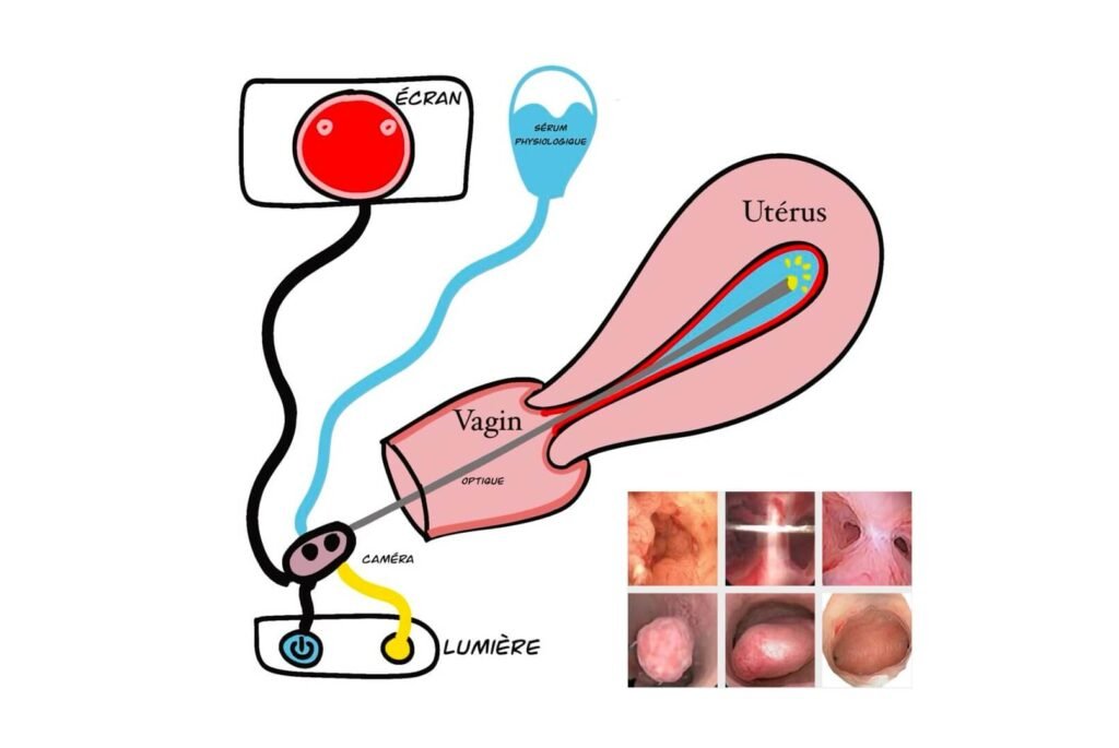 Diagnostic Hysteroscopy