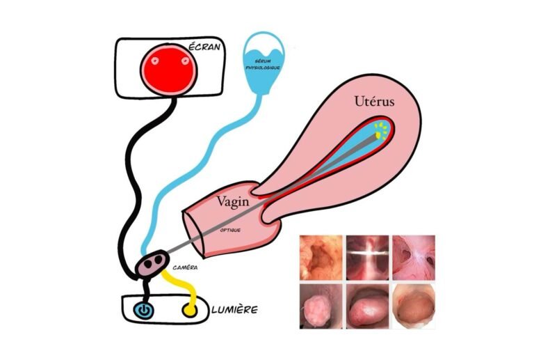 Diagnostic Hysteroscopy